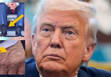 trump-diagnosed-with-chronic-venous-insufficiency:-condition-may-lead-to-‘amputation’-if-untreated,-claims-doctor